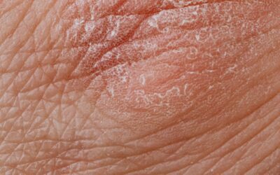 Managing Eczema with Homeopathy